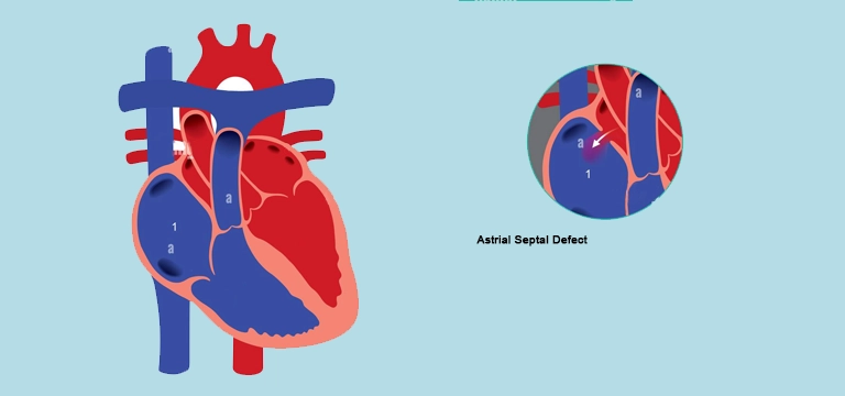 Atrial Septal Defect : An Overview of Diagnosis, Treatment and Outlook